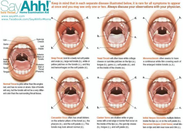The SayAhh! packaging comes with a medical-grade, illustrated chart and clear pictures and descriptions of six common throat ailments, providing the user a solid basis for comparison to what should be seen in a normal throat